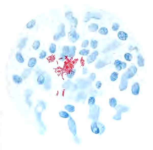 Tubercle bacilli in urinary sediment