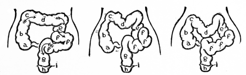 Image unavailable: Normal colon. Arrows show course of fecal matter.  Abnormal colon contracted and bent into curves by pressure of corset.  Abnormal colon prolapsed. This condition may result from general low vitality or from corset pressure. a, caecum. b, ascending colon. c, hepatic flexure. d, transverse colon. e, descending colon. f, f, f, sigmoid flexure. g, rectum. h, anus. i, sphincter ani.