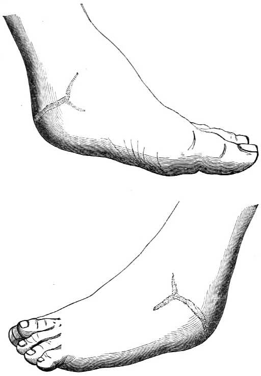 Exterion left and right view of ankle after operation is complete.