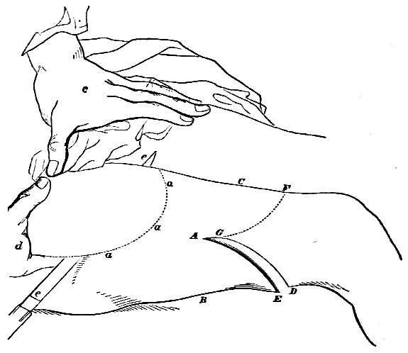 Illustration of where to cut for amputation of hip-joint.