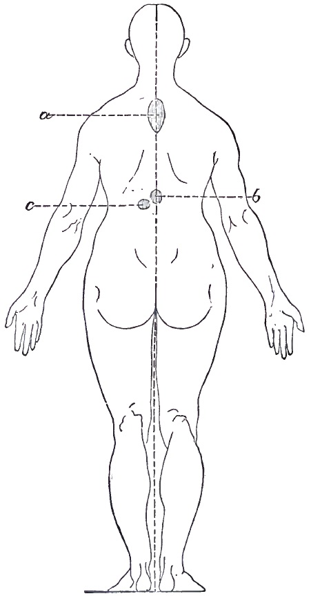 Posterior hysterogenic zones