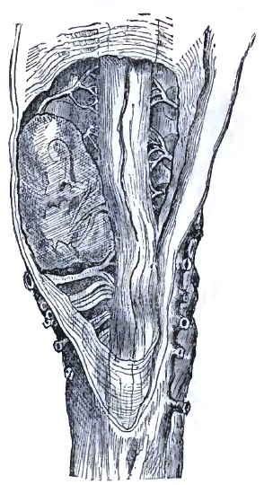 Fibroma lower dorsal cord