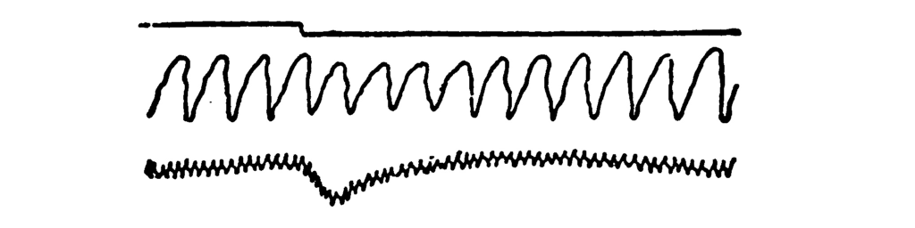 A polygraph record consisting       of three lines. The top line is straight except for a dip at the       one-third point. The middle line rises and falls a dozen times;       at the one-third point its curves become smaller for several       wavelengths. The bottom line consists of many small zigzags, and       dips down at the one-third point before slowly rising back to       its original height.