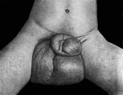 Fig. 98.—Elephantiasis of Penis and Scrotum in native of Demerara. (Mr. Annandale's case.)