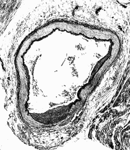 Fig. 2.—Cross section of a coronary artery, ×50, showing nodular sclerosis. Note the
heaping up of cells in the intima, the fracture of the elastica, and the destruction of the
media beneath the nodule. The primary lesion evidently was in the media. The thickened
intima is the effort on the part of nature to heal the breach. At such places as
shown here aneurysms may form. (Microphotograph.)