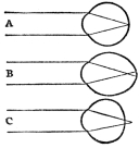 EYE LENS—NORMAL AND DEFECTIVE

A, normal eye; B, myopic eye; C, hyperopic eye (From Martin’s
“Human Body”)